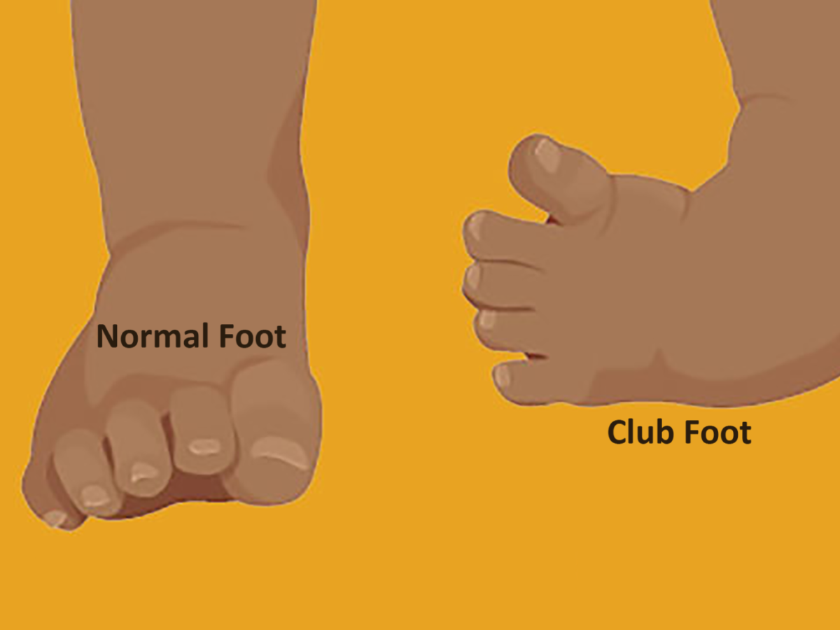 Clubfoot: Symptoms, Causes & Treatment
